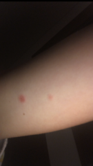 Ringworm exposure