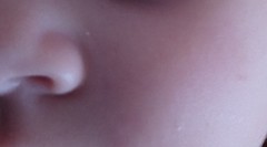 Is this milia?
