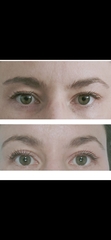 If you had an Upper Blepharoplasty
