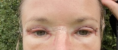 If you had an Upper Blepharoplasty