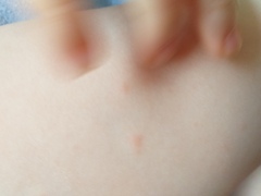 Is this chicken pox (photos included)?