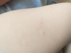 Is this chicken pox (photos included)?