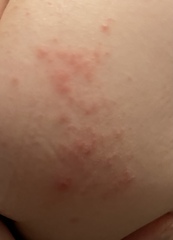 Another chicken pox/hfm (with pics)