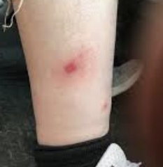 Spider bite or drama queen??