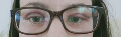 If you had an Upper Blepharoplasty