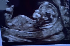 13 week gender prediction