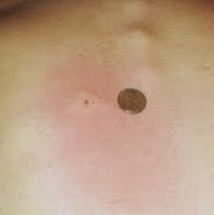 Spider bite or drama queen??