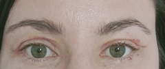 If you had an Upper Blepharoplasty