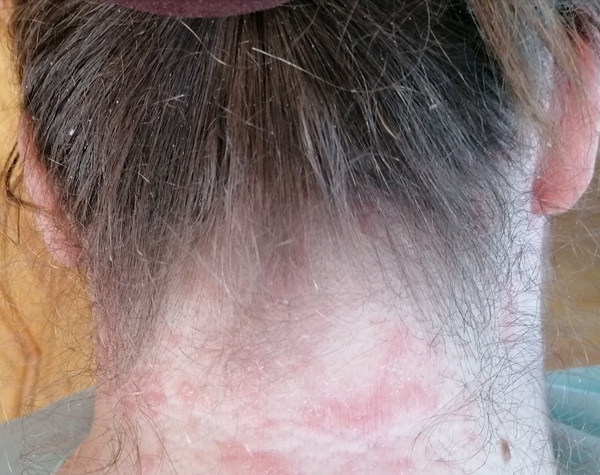 Dry skin and dandruff