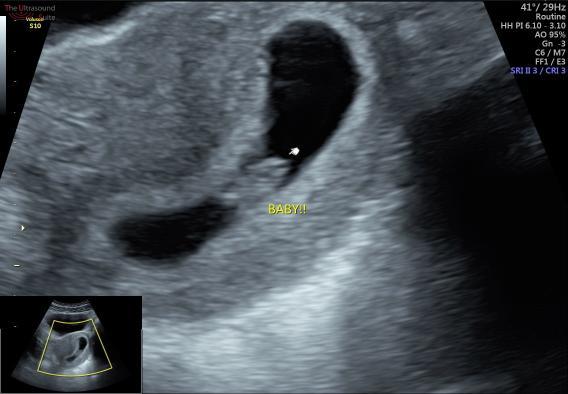 Gender guesses - Ramzi theory?