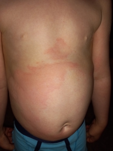 Can someone identify this rash?