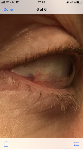 What have I done to my eye?
