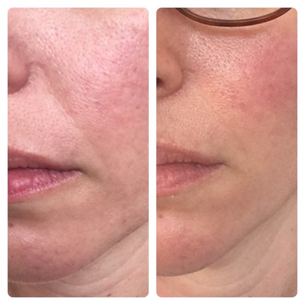 I’ve had a thread lift