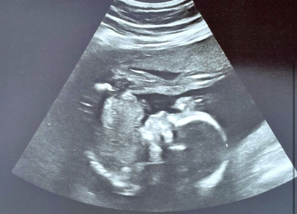 Due March / April 2022 2nd thread 2nd trimester