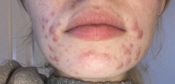 Hormonal acne: Accutane or spironolactone?