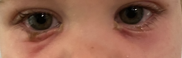 Conjunctivitis - how to care? And should the eyes look bruised?