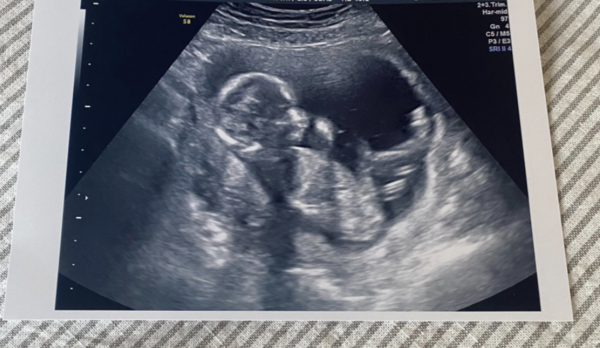 Hematoma bleeding, will it ever stop!? 17 weeks pregnant