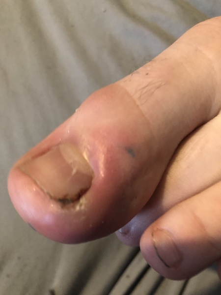 My son has an ingrown toenail -  does it need seeing today - picture warning