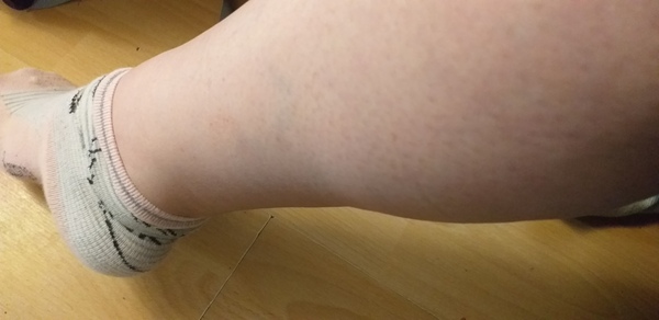 Feeling tired, odema, put in a stone in a month, breathless. Gp insists I am fine.