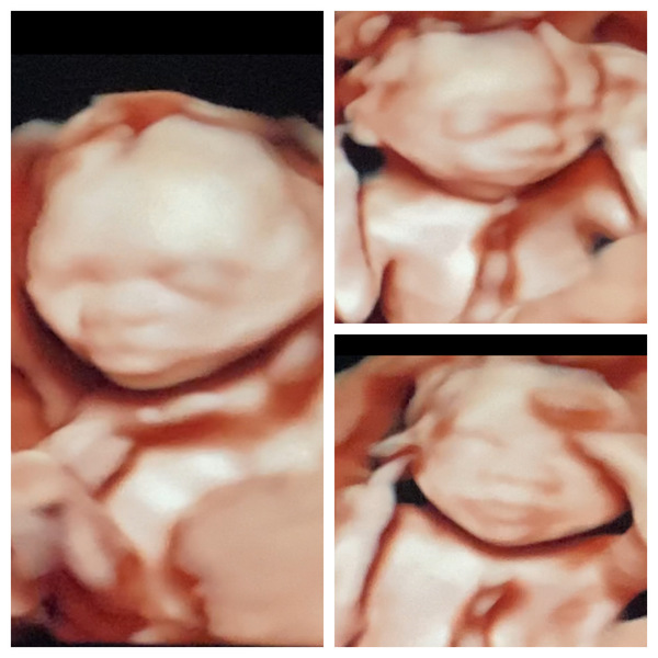 NIPT false positive for T18