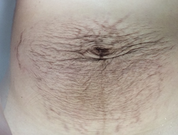 Twin Skin, depressed, skin hang over. Pictures for reference