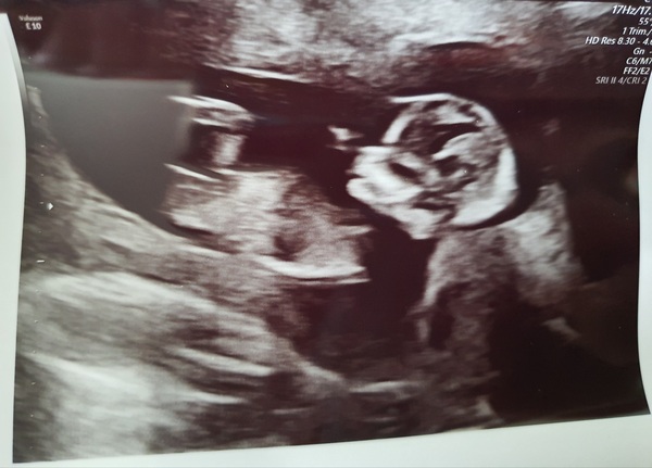Anyone else 5 weeks pregnant?