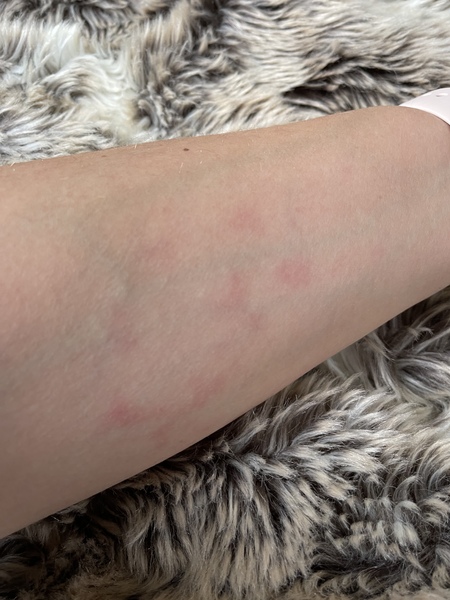 What is this rash on my arm? With pics