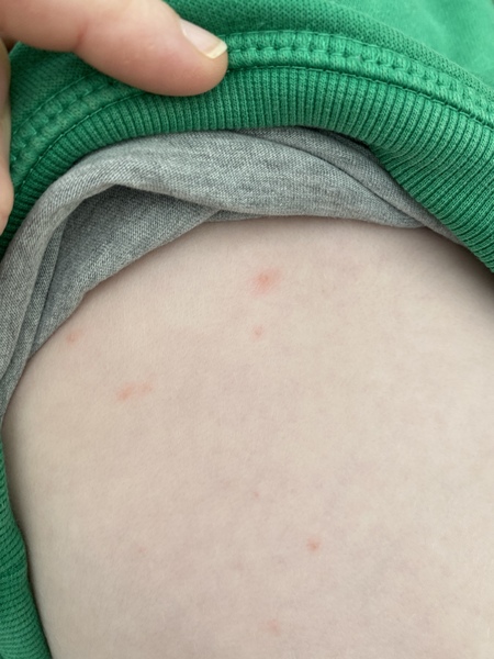 Are these chicken pox?