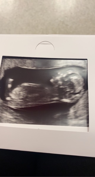 Can you tell the sex at a 12 week scan?