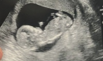 Anyone else 5 weeks pregnant?