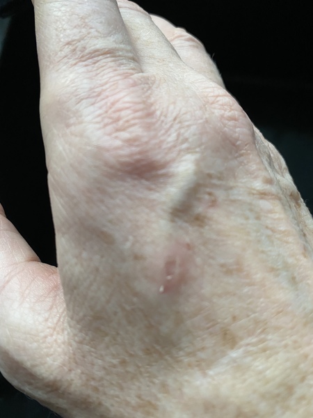 Tell me about your itchy flaky mole that wasn’t cancerous