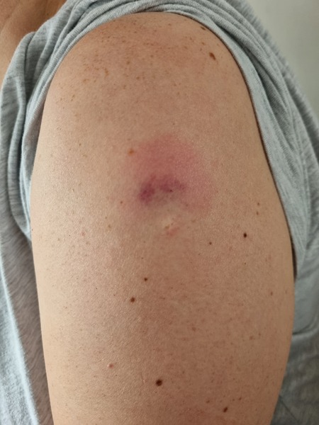 Pfizer booster jab site...does this look OK?