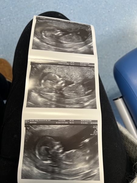 Pregnancy after 3 recurrent miscarriages