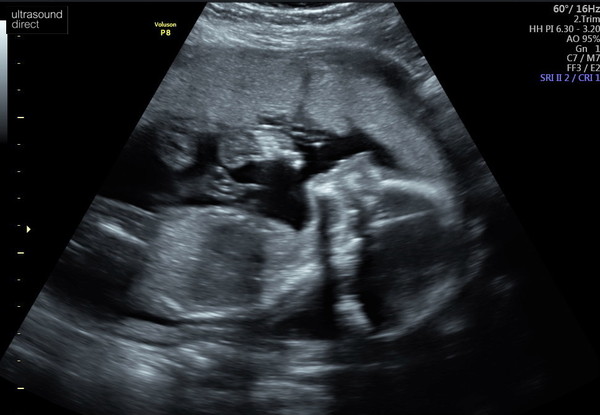 Due March / April 2022 2nd thread 2nd trimester