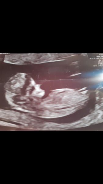 Nub predictions 11w6days