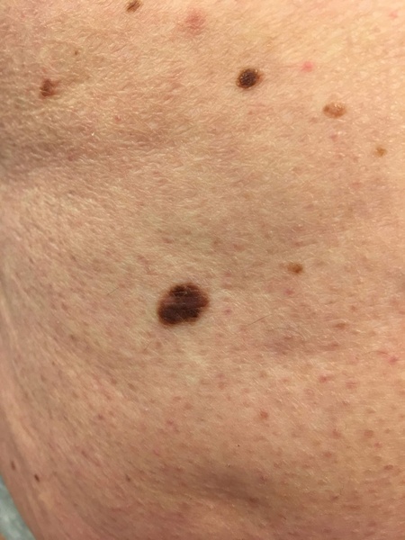 Anyone had a mole investigated?  GP has referred me to hospital.