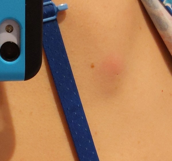 Sebacious Cyst - is it supposed to hurt this much?