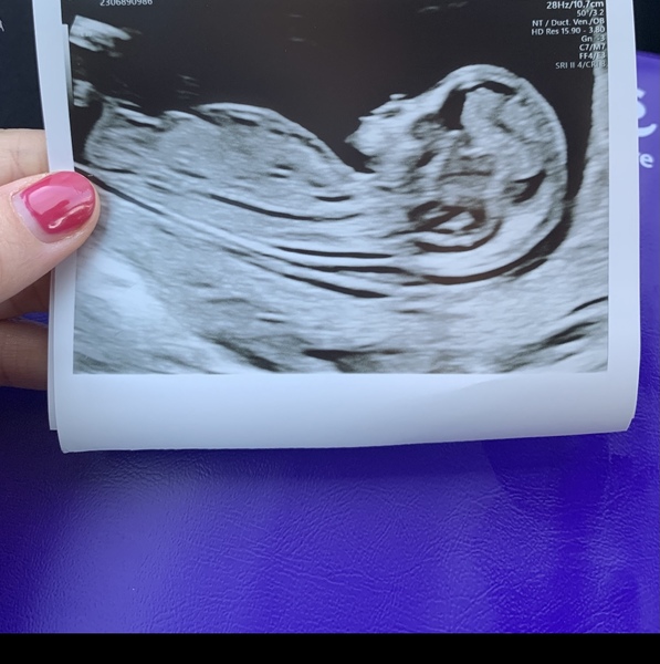 Anyone else 5 weeks pregnant?