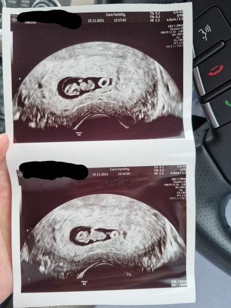 Any ivf pregnancies ?