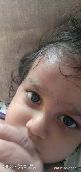Swelling on baby's forehead after a fall. When should I be concerned ?
