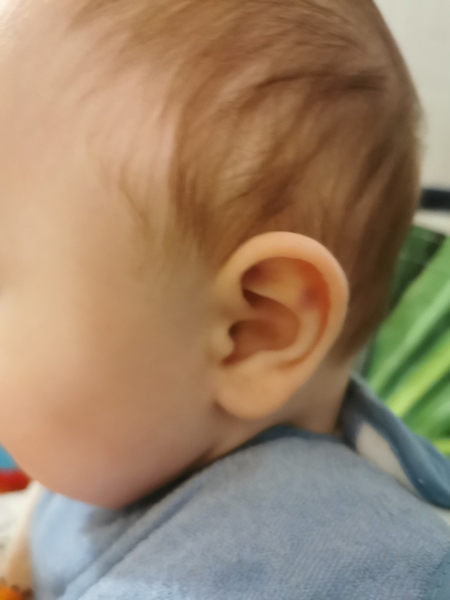 Purple mark on baby ear