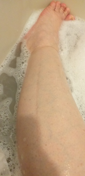 Feeling tired, odema, put in a stone in a month, breathless. Gp insists I am fine.