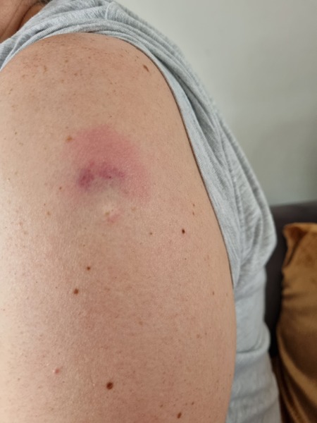 Pfizer booster jab site...does this look OK?