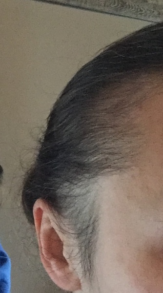 Postpartum Hair Loss - Go Short?