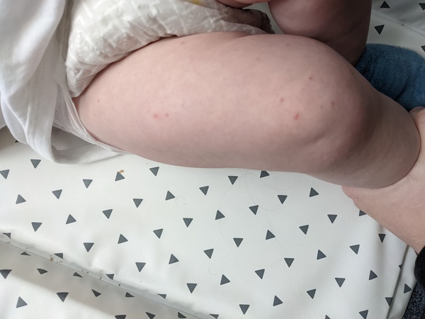 Chickenpox or HFM?