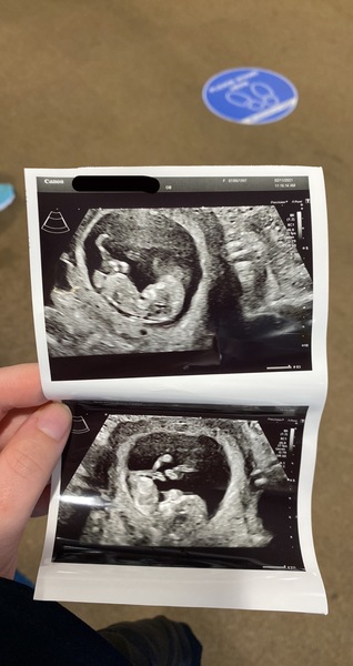 Pregnancy after 3 recurrent miscarriages