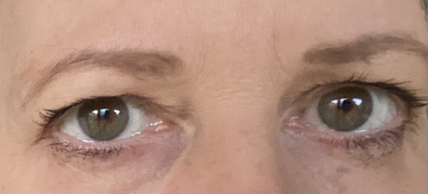 Saggy eye advice please - with photo