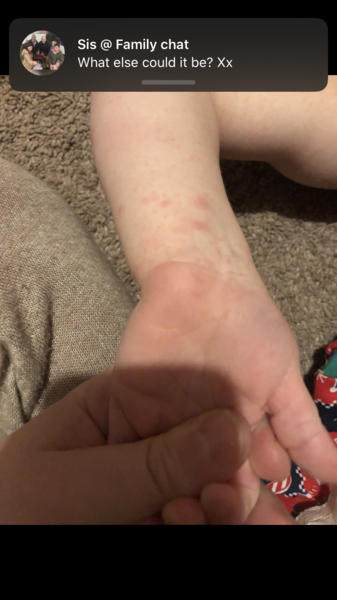 Help! Chicken pox or hand foot & mouth or none ?!!