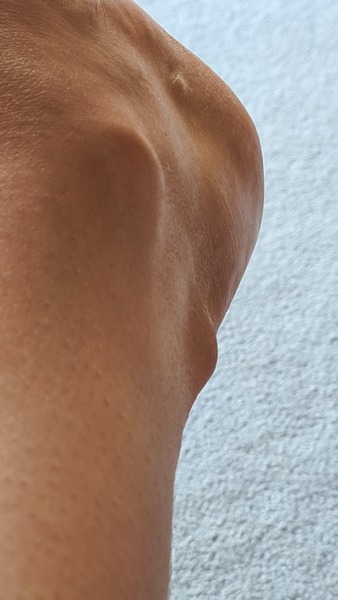 Achilles issues