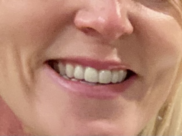 Getting teeth done - your recommendations
